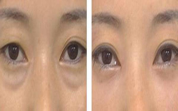 手术眼袋抽脂价格,自信与成长的投资之旅启程