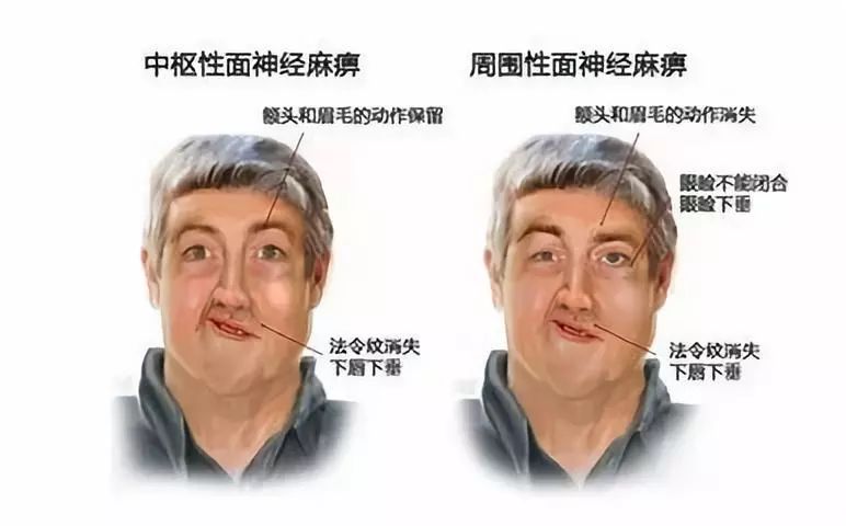 最新面瘫的日常趣事分享